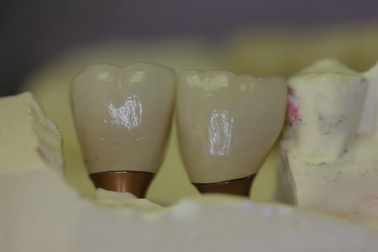 IMAGE: http://i77.photobucket.com/albums/j45/OH_Smilemaker/Dental/IMG_0558.jpg