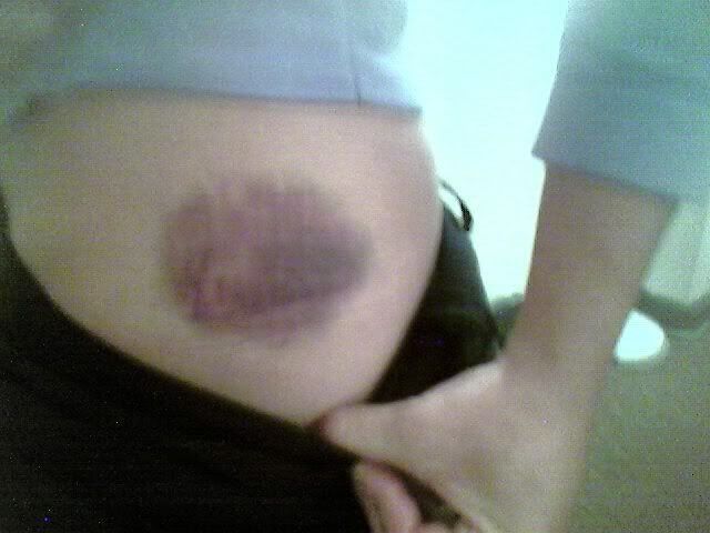 bruise2.jpg